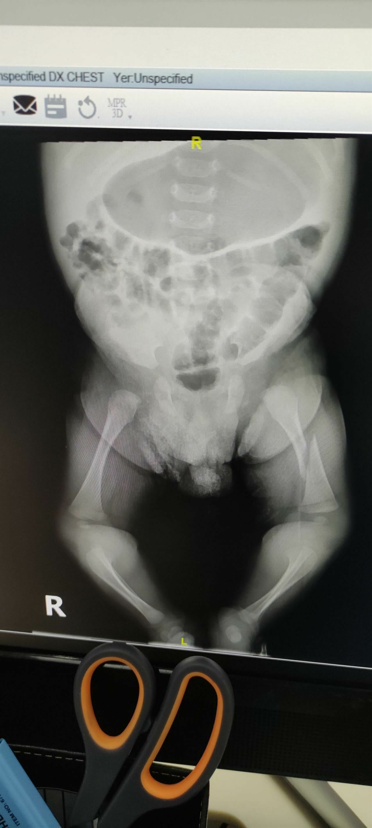 Bir aile, bir aylık bebeğinin bacağının özel bir hastanede kırıldığını iddia ediyor.