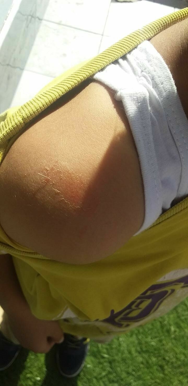 Adana'da Küçük Çocuğa Akran Zorbalığı Vücudu Morluklarla Dolu