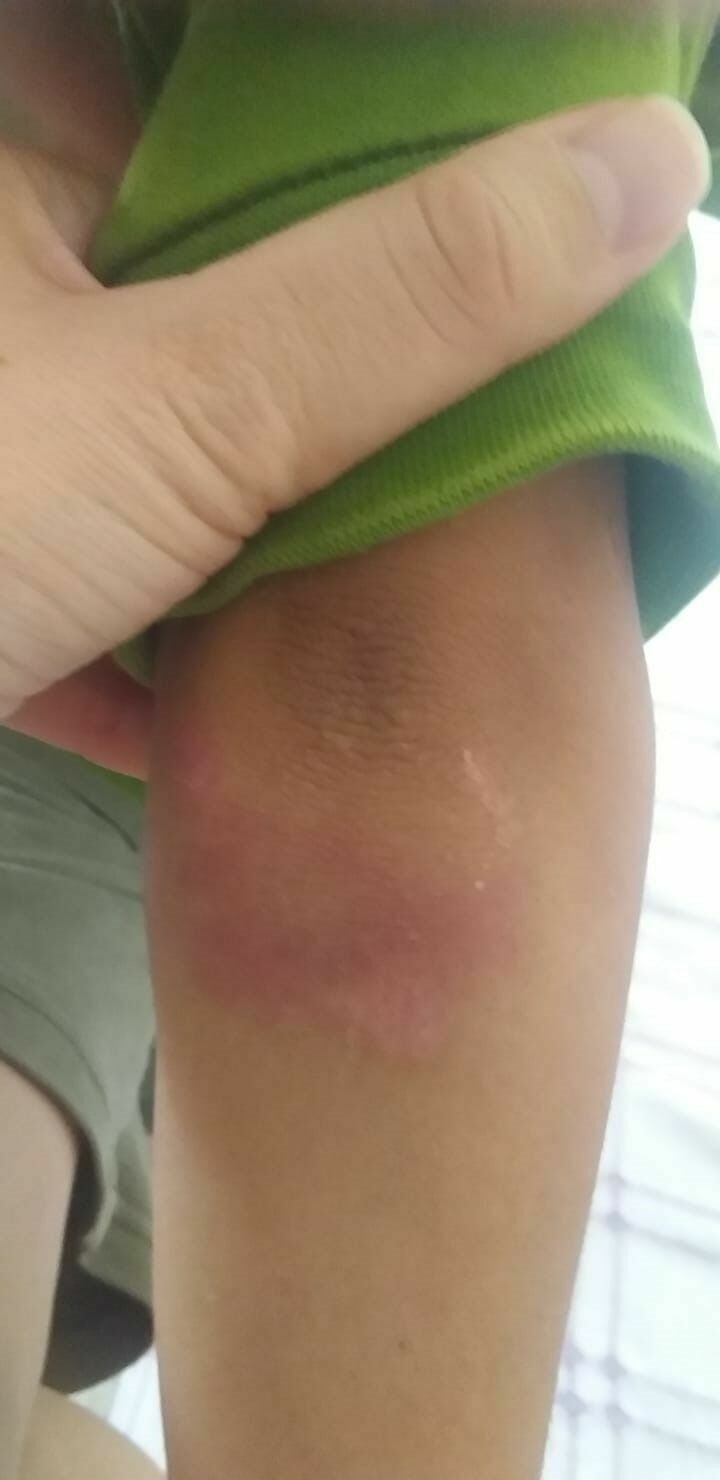 Adana'da Küçük Çocuğa Akran Zorbalığı Vücudu Morluklarla Dolu