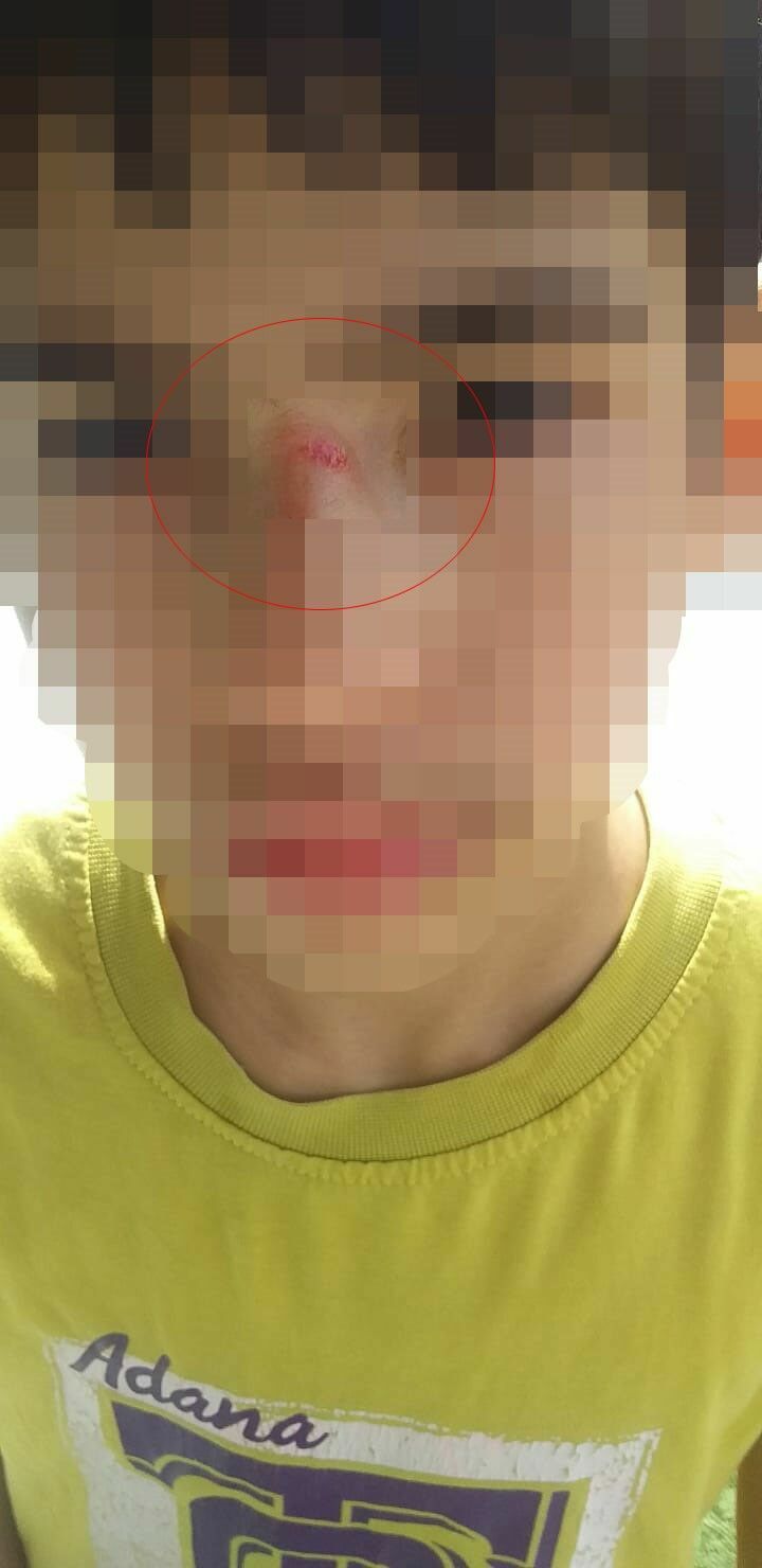 Adana'da Küçük Çocuğa Akran Zorbalığı Vücudu Morluklarla Dolu 