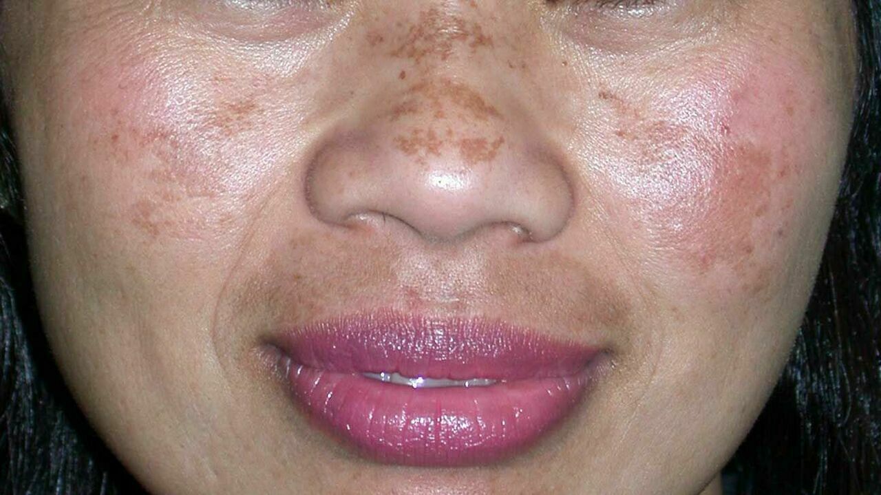 Fito Krem Cilt Lekelerini Giderir Mi