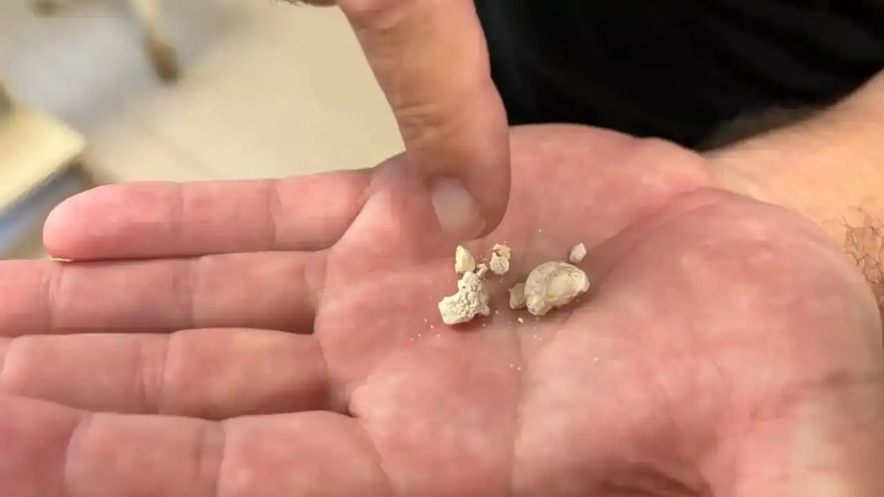 antalyada-tukuruk-bezinden-en-buyugu-2-santim-olan-5-tas-cikti-1