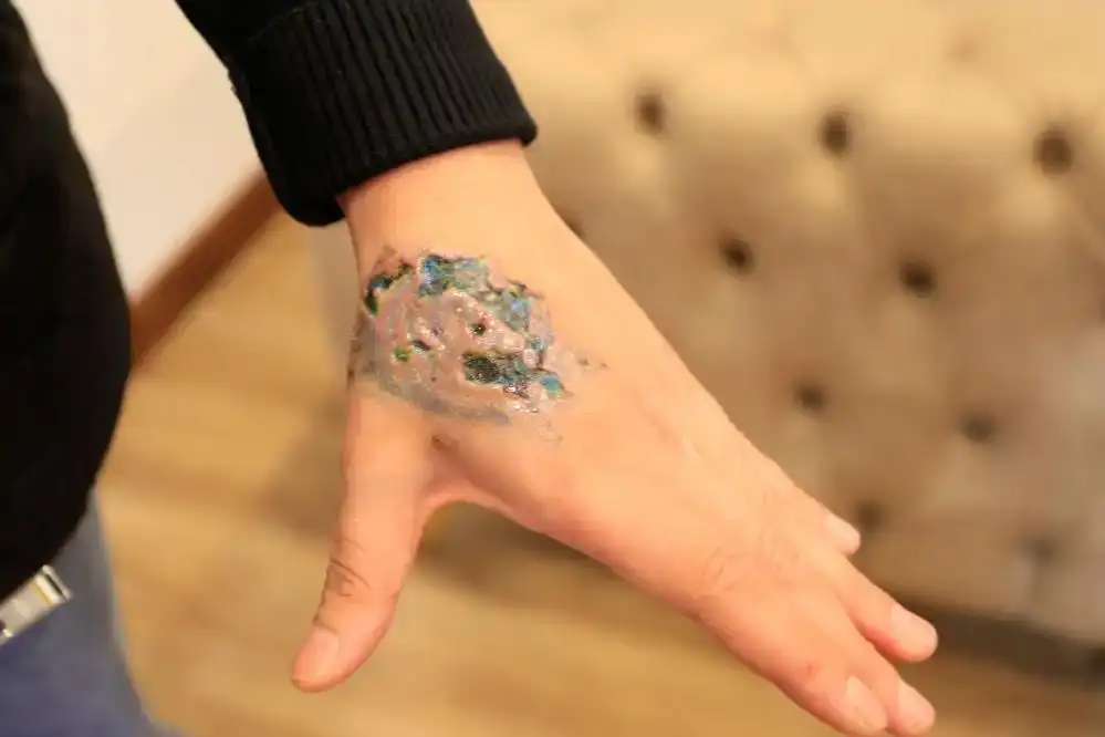 dovme-sildirmek-isterken-kabusu-yasadi-elinde-ikinci-derece-yanik-olustu