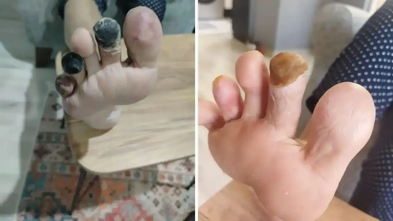 antalyada-kesilecek-denilen-parmaklari-ozel-solusyon-kurtardi